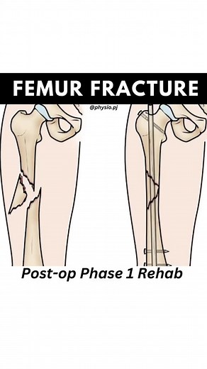 Rehabilitation Tips for Femoral Shaft Fracture