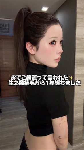 おでこが丸くてお気に入りﾐ^⸝⸝> ◦ <⸝⸝ ^ﾐ🎀 コンプレックスが生え際だったから改善できて嬉しいのともう1年経つって思うと早いなぁ できて良かった施術です 今回私が施術を受けた韓国のクリニックが、 9月6日に東京で相談会を開催するみたいだから 気になる子はチェックしてみてね！ #PR #植毛 #韓国植毛 #韓国美容 #ヘアライン矯正 @モモ植毛クリニック
