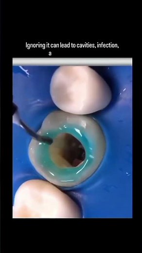 Tooth Filling Procedure Video - Dr. Sinha Dental Clinic #greaternoida