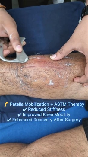 "Every gentle movement counts—Patella Mobilization with ASTM #phyiotherapy