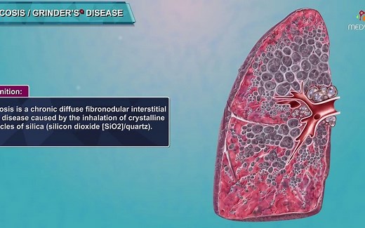 Silicosis | 硅肺（矽肺）