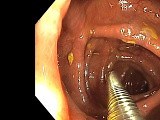 Endoscopic Giant Polyp Polypectomy - Transverse Colon • Video • MEDtube.net