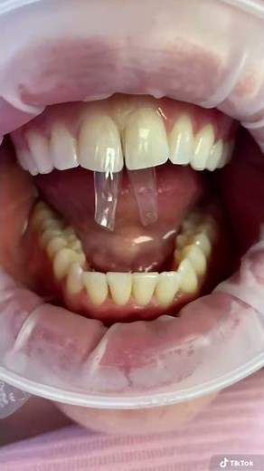 Diastema Closure - created with Bioclear Matrix