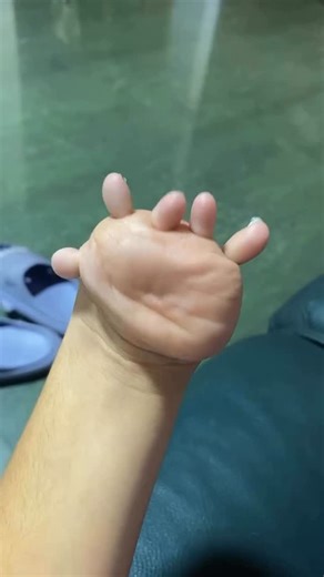 YAŞAM BURADA GÜNCELLENİYOR. on Instagram: "Bu nadir durum tıp literatüründe Ulnar Dimelia (halk arasında Ayna El Sendromu) olarak bilinir. Bu sendromda el simetrik bir yapıdadır, normal bir başparmak bulunmaz ve el ayasının iki yanında da parmaklar (genellikle 7 veya 8 adet) yer alır. Kemik ve yumuşak doku gelişimini kontrol eden genetik sinyallerin anne karnındaki süreçte farklı işlemesinden kaynaklanan çok nadir bir gelişimsel anomalidir. Paylaşımlarında mizahı kullanması durumu bir trajedi ol