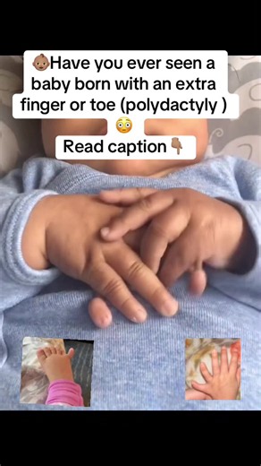 👶🏽 Did you know a baby can be born with an extra finger or toe? 🖐🏽🦶🏽 This condition is called POLYDACTYLY — a congenital condition where a baby is born with more than the usual number of fingers or toes. 🧬 Why does it happen? It can occur due to genetic factors and may sometimes occur as part of a genetic syndrome. In many babies, it occurs on its own. 🩺 Management: • The baby should be examined to determine the type of extra digit and whether it contains bones, joints, nerves or blood v