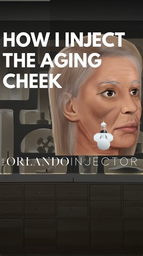Orlando Injector - Alexis Bowhay, PA-C | The midcheek groove is a common sign of midface aging caused by fat pad descent and volume loss. Strategic filler placement directly on... | Instagram