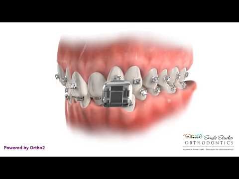 Damon Q Bracket -Braces