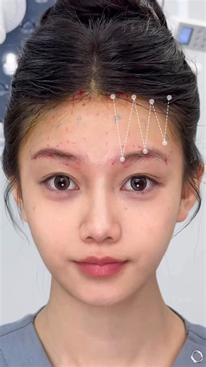 Xiao Zhong Ye on Instagram: "✨ Forehead Lift Testimonial | Camera-Facing Confidence Restored ✨ “I’m very satisfied. My only regret is not coming sooner.” She traveled from Nanjing to see Dr. Xiao for a forehead lift. As an e-commerce live streamer, long nights and constant screen time had taken a toll: • Heavy, sagging upper face • Short brow–eye distance • Hidden double eyelids • Drooping eye corners These issues had bothered her for years. After treatment, the changes were clear: Brighter eyes