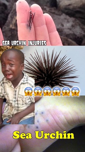 Sea urchin sting… OMG it hurts so bad! 😱🔥 #SeaUrchin #SeaUrchinSting #DangerousSeaUrchin #SeaUrchinRemoval #OceanDanger #BeachLife #SeaCreatures #WildSeaLife #OuchMoment #PainfulSting #SeaAdventure #ViralVideo #TravelVibes #UnderwaterWorld | Sea to Street