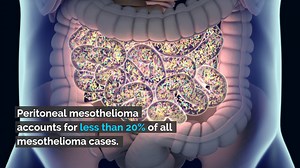 5.8K views · 26 reactions | Peritoneal mesothelioma develops in the lining of the abdomen. Learning about the cancer's symptoms now can lead to early diagnosis and a better prognosis. | The Mesothelioma Center | Facebook