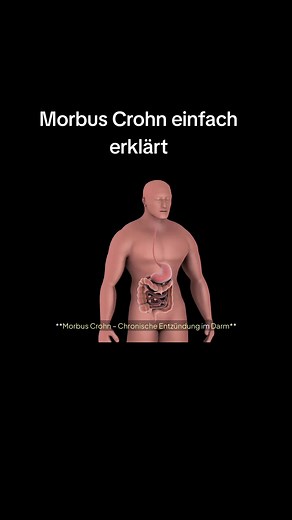 Understanding Morbus Crohn: A Comprehensive Overview