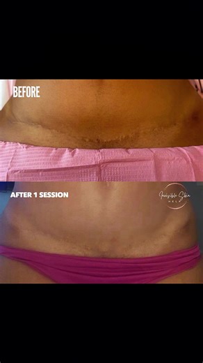 Invisibleskinhelp (@invisibleskinhelp)’s videos with original sound - Invisibleskinhelp