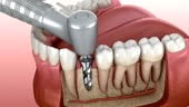 3D animation of Drilling, implantat instalation, abutment and crown...