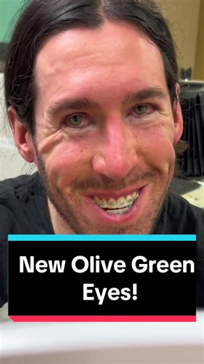 Beautiful Olive Green eyes! ColorEyes is quick and life-changing for so many people, to at last have rhe color they always wanted. We can titrate desired intensity levels of each color: 1) low intensity - more subtle, 2) medium intensity - moderate effect, or 3) high intensity - high impact. The procedure is overall very safe, sometimes scratchiness or light sensitivity that usually goes away after a couple of days (if even experienced at all). No infections have occured in past 16 years. This p