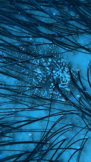 Dermoscoppic on Instagram: "Seborrheic keratosis #dermoscopy #dermoscope #derm #skinlesion #dermatology #dermoscopyexcellence #dermatoscopy #woodlamp #seborrheickeratosis #seborreia"