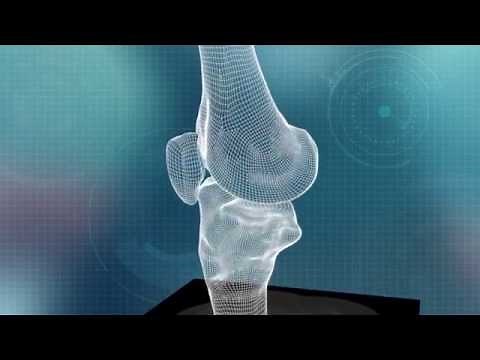 ConforMIS iFit Technology Platform Animation
