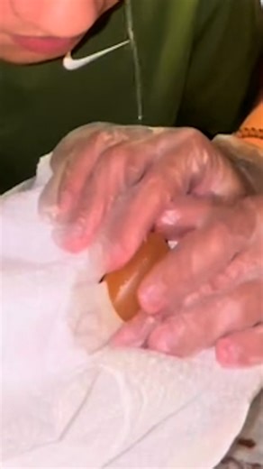Trigger Warning: Huge Blister Pop 🤢 | VT