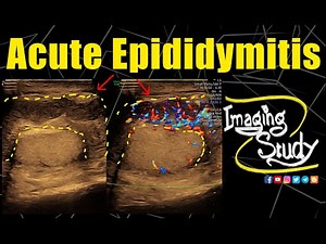 Acute Epididymitits || Ultrasound || Case 339