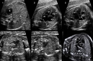 Pediatric Heart Disease Diagnosis - Biomedical Computer Vision