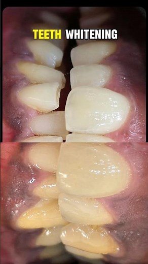 Before After Teeth Whitening 😱 | Real Dental Result #teethwhitening