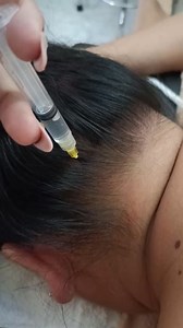 Terapia Neural y Medicina china La neuralgia occipital o dolor de cabeza occipital es una afección que provoca dolor agudo y punzante en la parte posterior de la cabeza o cuello. Este dolor puede ser debilitante y, a menudo, se confunde con un simple dolor de cabeza. Si sientes molestias en esta zona, ¡es importante que te hagas revisar por un especialista! 🧠💥�Con tratamiento adecuado, la neuralgia occipital puede aliviarse y mejorar tu calidad de vida. 👩‍⚕️ Si el dolor en tu cuello o cabeza 