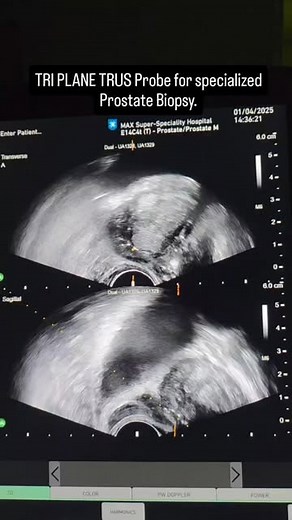 Dr Aditya Sharma on Instagram: "TRI PLANE TRUS Probe for specialized Prostate Biopsy. Beautifully demonstrates individual zones of the prostate. Thin probe, extremely comfortable for patients. Can also be used to diagnose prostatic cysts or abscesses. #ProstateHealth #MedicalTechnology #Urology #PatientCare #Healthcare"