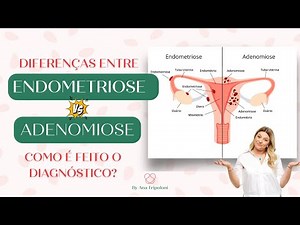 🎗️ Endometriosis vs. Adenomyosis: Understanding the Differences and Diagnosis | Ana Tripoloni #7