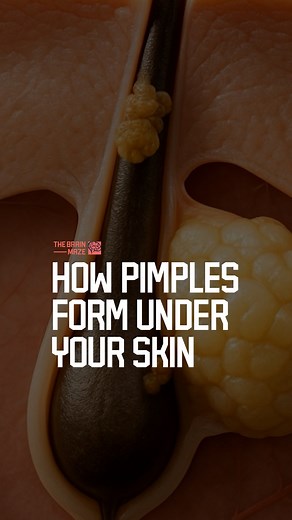 How Pimples Really Form Under Your Skin - What happens under your skin isn’t as simple as a pimple. This is the hidden chain reaction you never see. If you’re enjoying the content and want to support us, consider subscribing! | The Brain Maze
