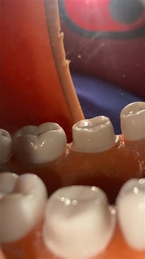 How to do a crown prep on tooth 30🦷