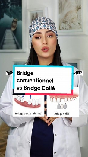 Différences entre le bridge conventionnel et collé