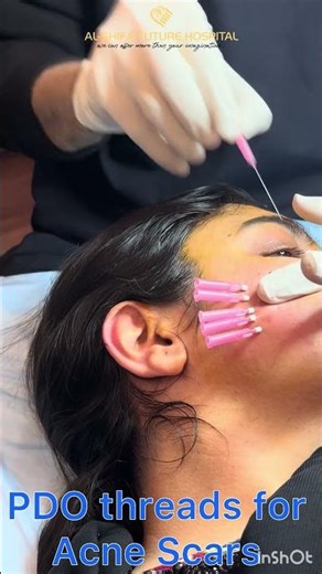 Remove Acne Scars & Lift Your Skin with PDO Thread Therapy | Al-Shifa Future Hospital
