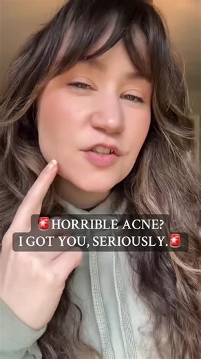 TREAT HUGE CYSTIC ACNE CRAZY FAST #cysticacnetreatment #ACNE #clearskintips #pimplepopping #pimplepatch