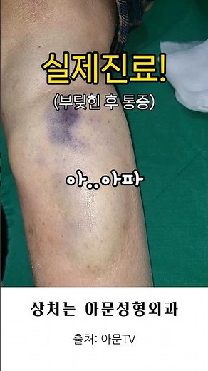 Bruise and pain treatment after a bump? (Bruise ultrasound examination, actual cost, actual loss ...