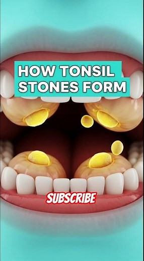 How Tonsil Stones Form 😬🦠 #viral #cgianatomy #tonsils