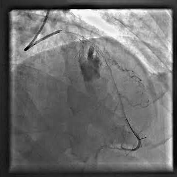 coronary perforation, primary pci