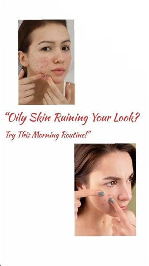 Tired of oily skin & acne? Here’s a dermatologist-approved simple routine 👌