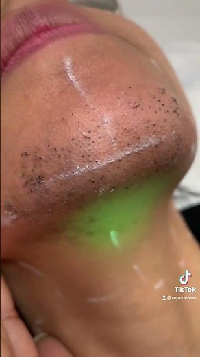 Laser hair removal on the chin