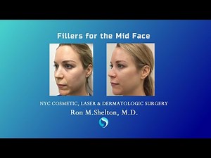 How to Restore Youthful Volume in the Mid-face using Fillers | Injectable Fillers by Dr Ron Shelton
