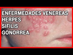 Qué son las Enfermedades Venereas: Sifilis, Herpes y Gonorrea