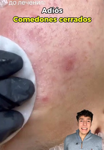 Si tienes comedones cerrados, textura o la piel con pequeño granitos la limpieza puede hacer una gran diferencia 👀✨ Este limpiador en espuma con 2% de azufre coloidal de @numbuzin ayuda a limpiar profundamente la piel, eliminar el exceso de grasa y dejarla mucho más suave, sin esa sensación pesada después de lavar el rostro. Una opción que me gustó especialmente para pieles con tendencia a imperfecciones y textura 💚 @numbuzin_es #ZeroBlemish #bumpyskin #texturedskin #acneprone #closedcomedones