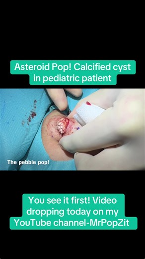 You see it first Tik Tok! This video will be uploaded today on my YouTube channel-MrPopZit. Interesting case alert! This calcified cyst is like a sac of pebbles in this little girls neck! She was so brave! Thanks to her for sharing her procedure so other little kids know what to expect when they come in. #mpzdermatology #mrpopzit #dermatology #medicaleducation #cyst