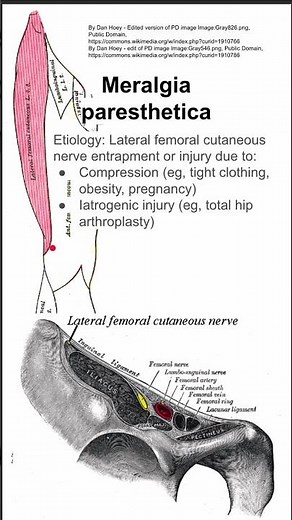 Meralgia paresthetica