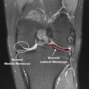 Discoid Meniscus: What to Look For?