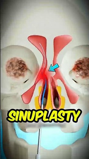 Doctors Use a Tiny Balloon to Fix Your Blocked Nose 🎈 #balloonsinuplasty #MedicalFacts