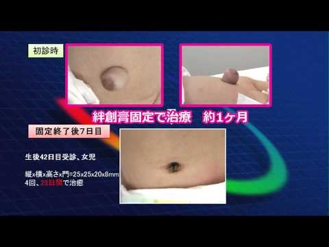 「徳島大学病院」TVいきいきらいふ第50回子どものでべそについて