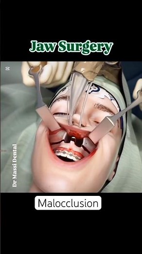 Jaw Surgery • “From Overbite to Perfect Bite” • “Orthognathic Surgery in Action”