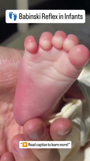 Babinski Reflex