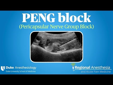 PENG Block (Pericapsular Nerve Group Block)