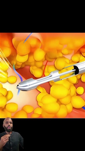 This is how liposuction is done