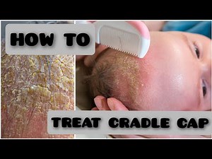 How to Treat Cradle Cap.Newborn baby. #newborn #cradlecap